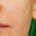 La imagen 4 de la Empresa DR. ERICK MARÍN - DERMATÓLOGO Rosacea en Antofagasta AN